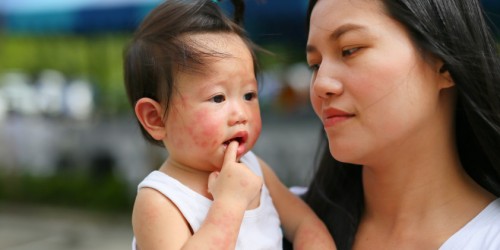 Atopic Dermatitis and Babies: Should You Treat Eczema in Infants with Medications or Naturally?